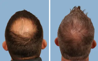 Before and After